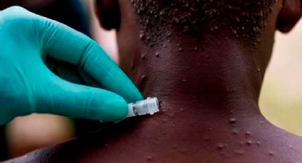 África, el único continente con muertes por viruela del mono que NO tiene vacunas
