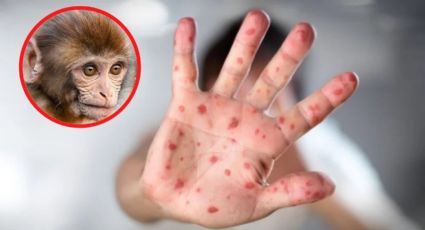 EU declara emergencia de salud nacional por viruela del mono; estos son los contagios en cada estado