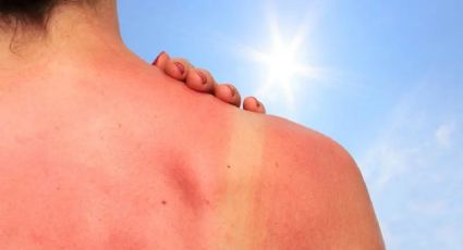 3 remedios que FUNCIONAN para las quemaduras de sol