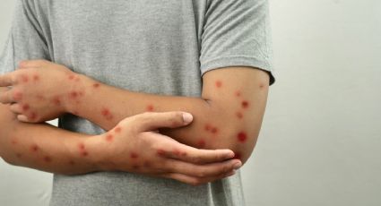 Qué lugares de Estados Unidos están presentando casos de sarampión y por qué preocupa a autoridades