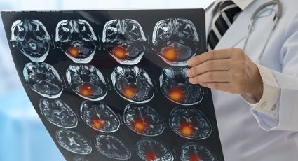 ¡Buenas noticias! Este casco magnético es capaz de reducir tumores cerebrales en personas con cáncer